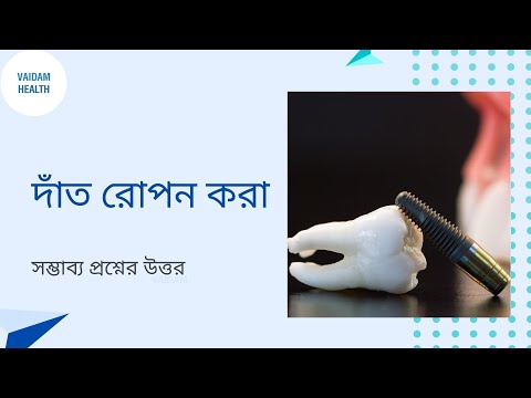দাঁত প্রতিস্থাপন -সচরাচর জিজ্ঞাস্য