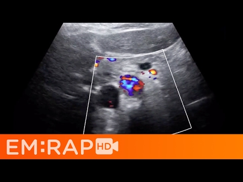 Ultrasound of Aortic Dissection