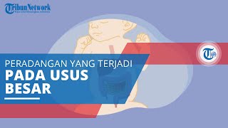 Necrotizing Enterocolitis, Kondisi Peradangan yang Terjadi pada Usus Besar atau Usus Halus
