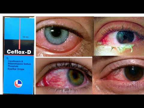 Ciplox D Eye Drops Review