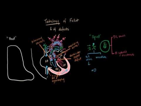 Tetralogy of Fallot