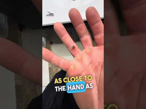Healing Secrets: How to Care for Calisthenics Ripped Hands