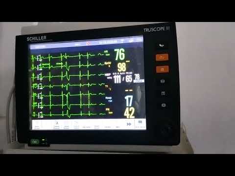 case of Ventricular Bigeminy changing to Trigeminy and Quadrigeminy