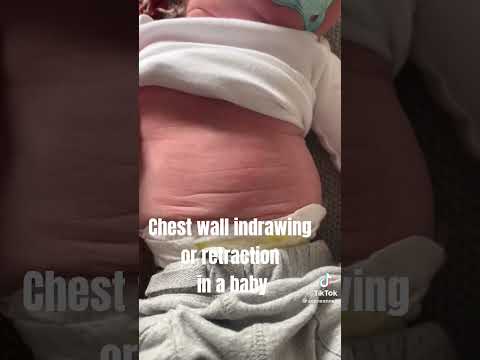 குழந்தைக்கு சுவாசிப்பதில் சிரமம் l குழந்தையின் வேகமான சுவாசம் #tamil