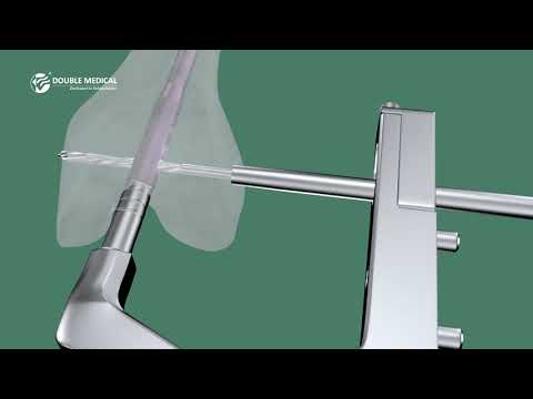 Double Medical Distal Femoral Nail DFN II