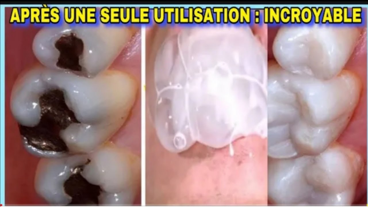 Si tu es fatigué de la Mauvaise Haleine  , alors élimine la rapidement et définitivement