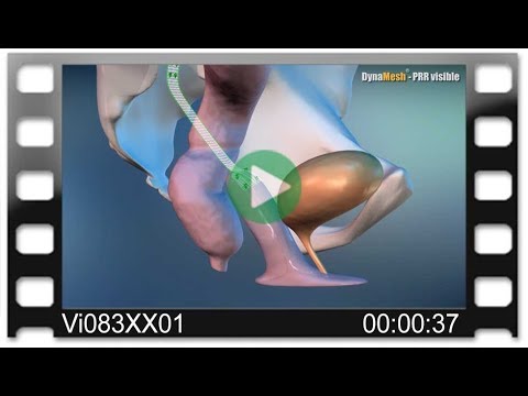 DynaMesh®-PRR - Animation: Colposacropexy