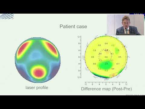 AIOS2025 RF Refractive FP3072 Dr Thomas KOHNEN Safety and Efficacy of Customised Photorefractive