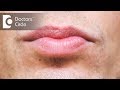 What causes discoloration below lip & its management? - Dr. Sachith Abraham