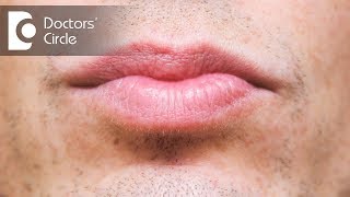 What causes discoloration below lip & its management? - Dr. Sachith Abraham