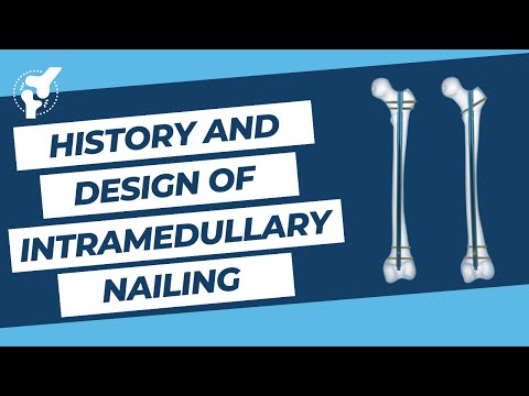 The History and Design of Intramedullary Nailing - From Kuntschner to Reamed Titanium Nails