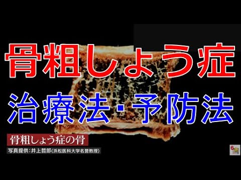 骨粗しょう症 – 骨粗鬆症とは何か、症状、治療法、原因、ヒント