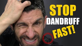 5 Tips On How To Get Rid Of Dandruff... FAST! Best Home Remedies, Shampoos and Treatments