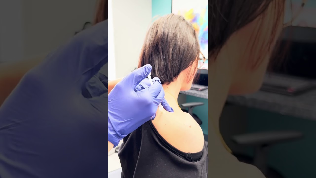 Botox Injections Trapezius Muscles for Pain and Slimmer Neck and Shoulders