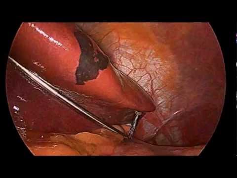 EndoLift for Liver Retraction During Sleeve Gastrectomy [2]