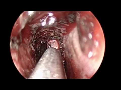 Acute Infection of Sphenoid Sinus Treated by Sphenoidotomy