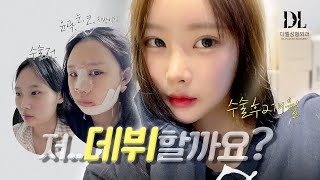 디엘 아이돌라인???? | #윤곽3종 #코성형 #눈성형 #디엘성형외과