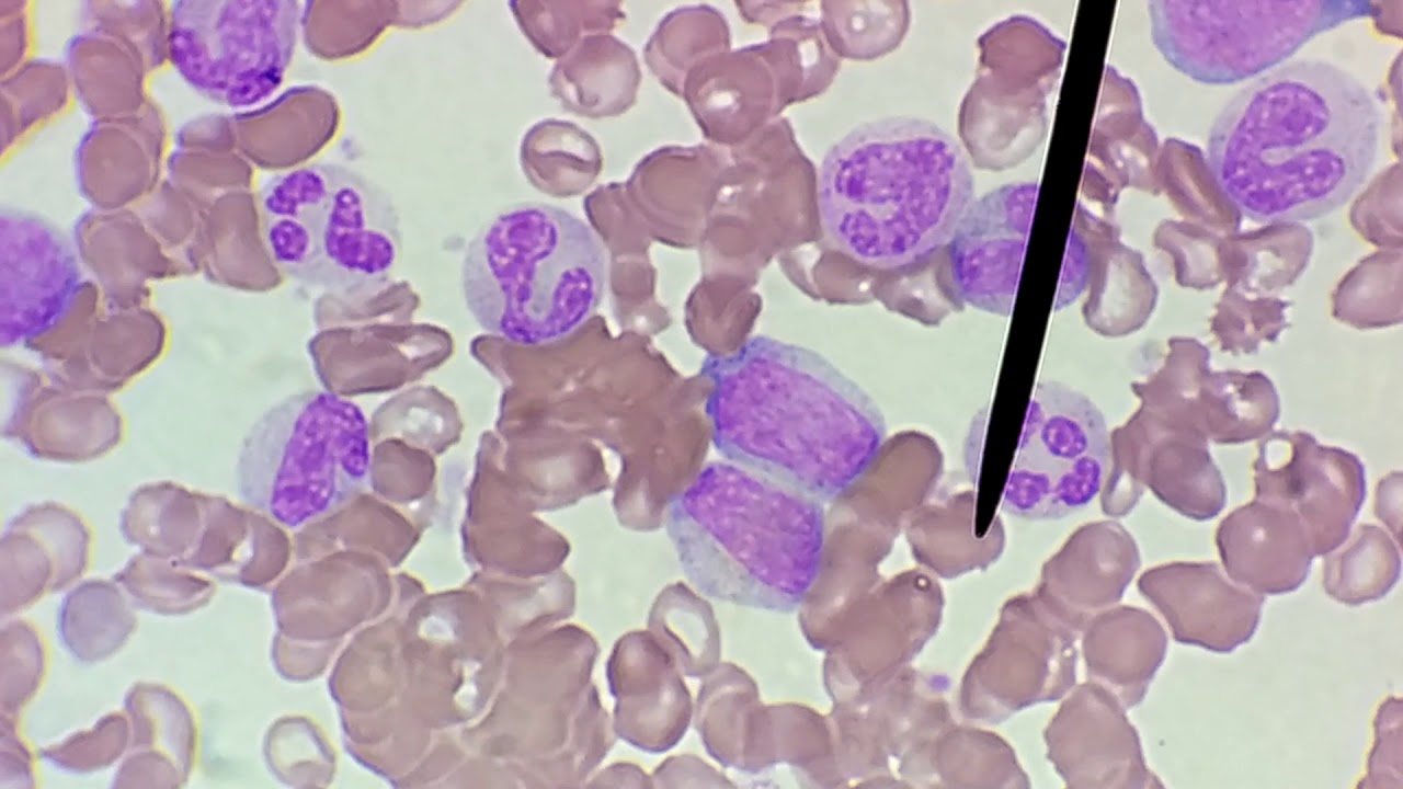 Metamielócito, Bastonete ou Segmentado?