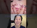 The Skinny on the Upper Lip Lift! #shorts #liplift