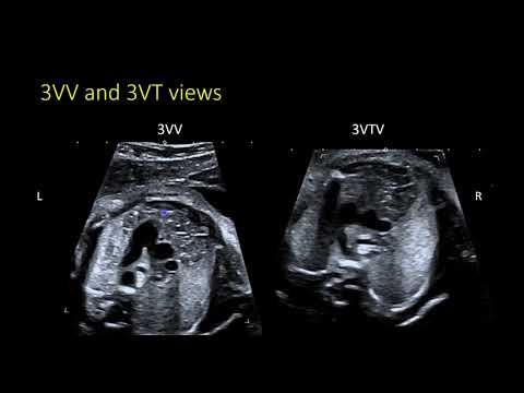 Fetal Echocardiography: The 3VTV and identifying arch abnormalities