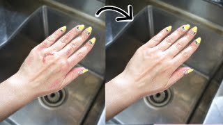 How to get rid of Ringworm from your hands!