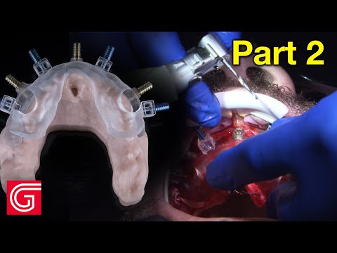 Guided Implant Surgery — Multi-Level Surgical Guide