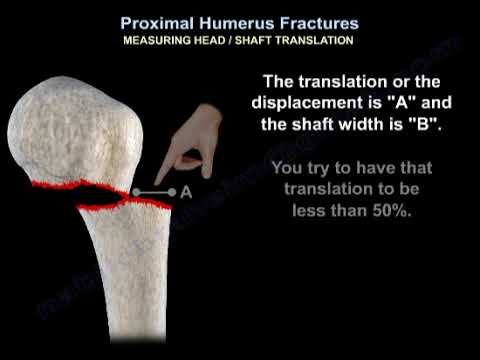 Złamanie bliższej nasady kości ramiennej - Dr. Nabił Ebraheim