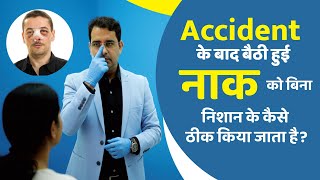 टूटी हुई नाक को बिना निशान के दोबारा बनाया जा सकता है! | Septo Rhinoplasty Surgery Explained