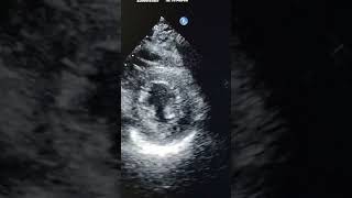 Download lagu 'Left Ventricle Contractility: Short axis View 💪❤️ #HeartHealth #Cardiology' mp3 Download lagu 'Left Ventricle Contractility: Short axis View 💪❤️ #HeartHealth #Cardiology' mp3