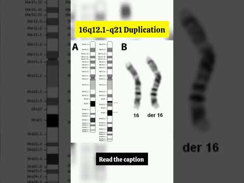 Chromosome 16 Duplication #science #genetics #shorts