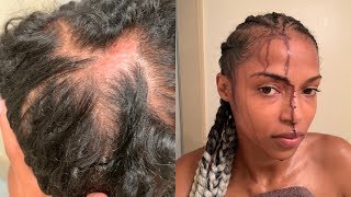 Scalp Irritation from Afreezm Braiding Hair