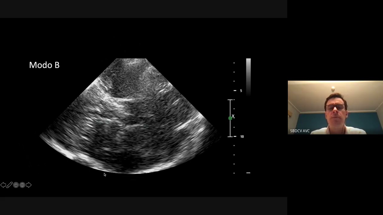 Doppler Transcraniano: POCUS em Neurologia Vascular