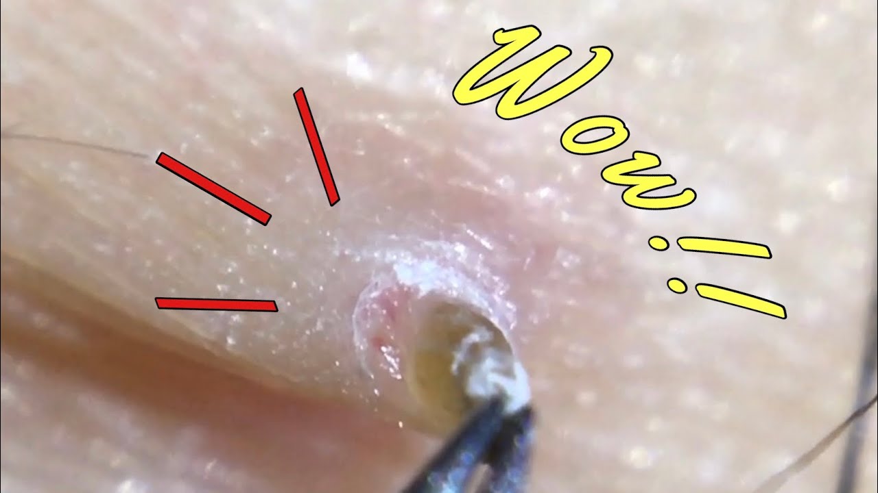 No.19 角栓引っこ抜 く！！pull out a huge angle plug by tweezers.