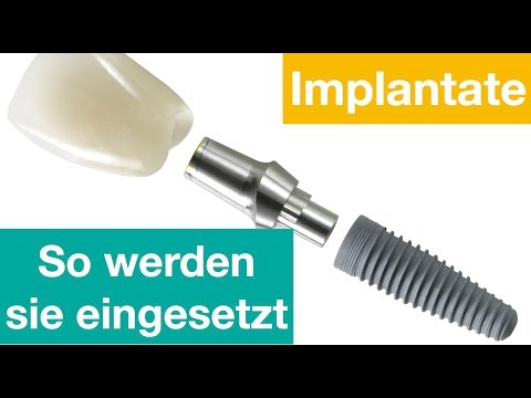 So werden Implantate eingesetzt
