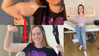 Así están mis brazos a 1 mes de la extracción de lipedema | 1 month lipedema postop | GLADYS SEARA