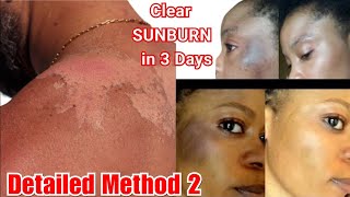 Do this NOW to get rid of SUNBURN and Treat Damaged SKIN caused by CREAM #sunburn #skincare #scars