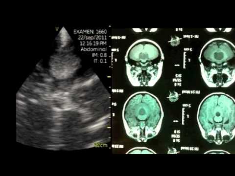 Pocket-Sized Examination During Surgery Of The Vermis Medular Tumor (Cerebellum) 