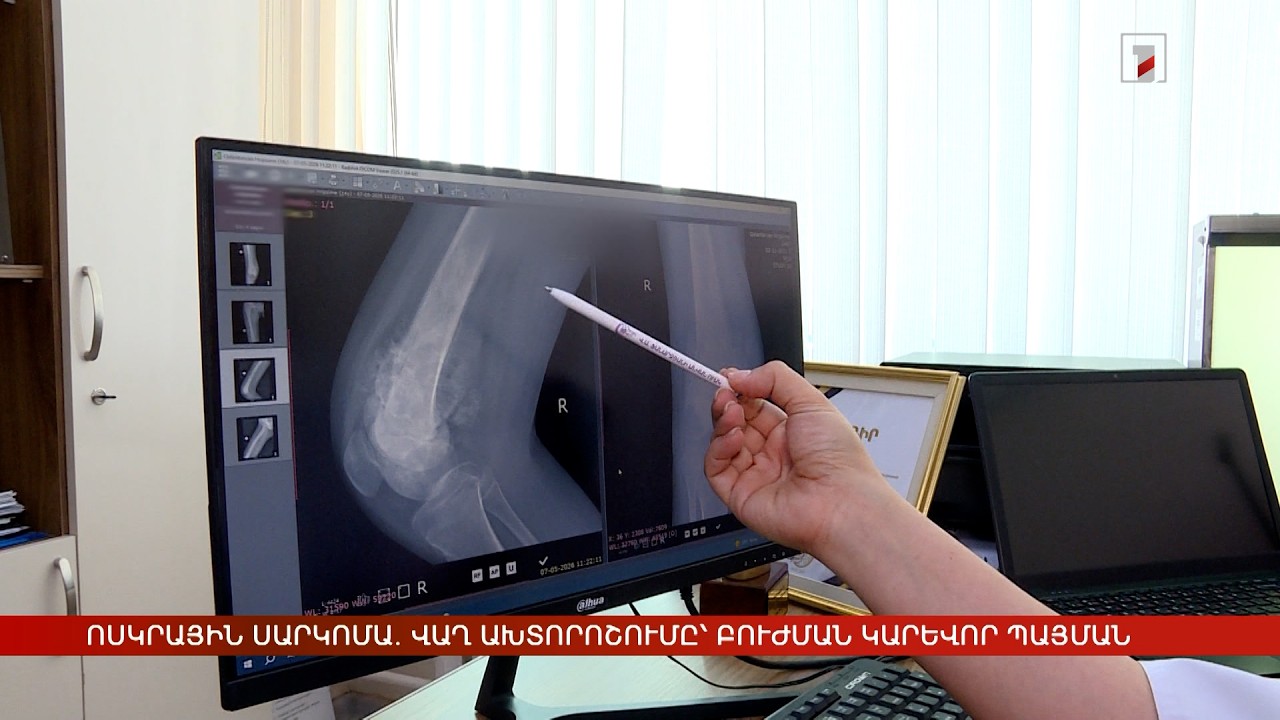 Ոսկրային սարկոմա․ վաղ ախտորոշումը՝ բուժման հաջողության կարևոր պայման