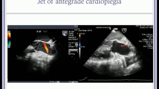 Dr Ian Harley: Anaesthesia & echocardiography during aortic valve replacement & repair