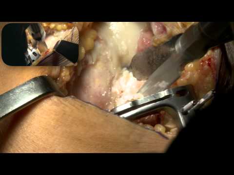 Sorgenti termali di Ungheria per il trattamento dei giunti Spalla periartroz periartroz articolazione della spalla o congelati