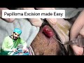 Scalp Papilloma How To Excise Papilloma Easily Dr Tayyab Riaz Ch
