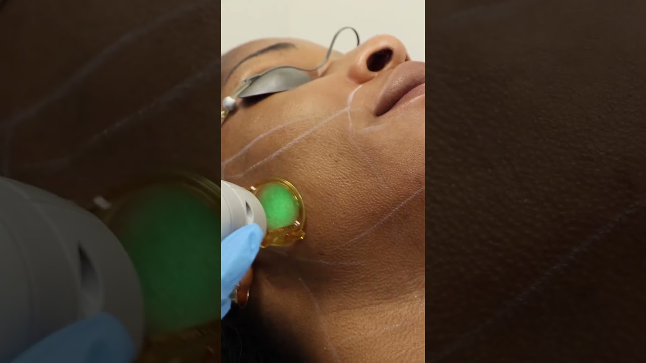 RobsDigital video production portfolio hair removal