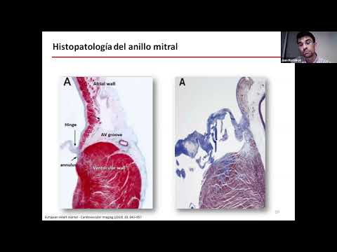 PROLAPSO MITRAL ARRITMOGENICO / CUANTIFICACION DE LA INSUFICIENCIA MITRAL. 1º MODULO