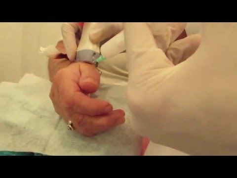 INFILTRACION ECOGUIADA RIZARTROSIS
