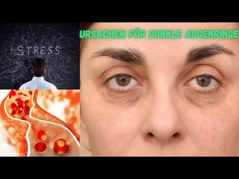 10 Ursachen für dunkle Augenringe und wie man sie bekämpft