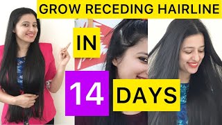 How to Grow Receding Hairline Naturally in 14 Days