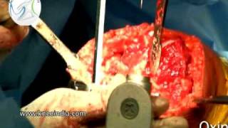 preview picture of video 'Oxinium Knee Replacement - Venkatachalam Part 1'