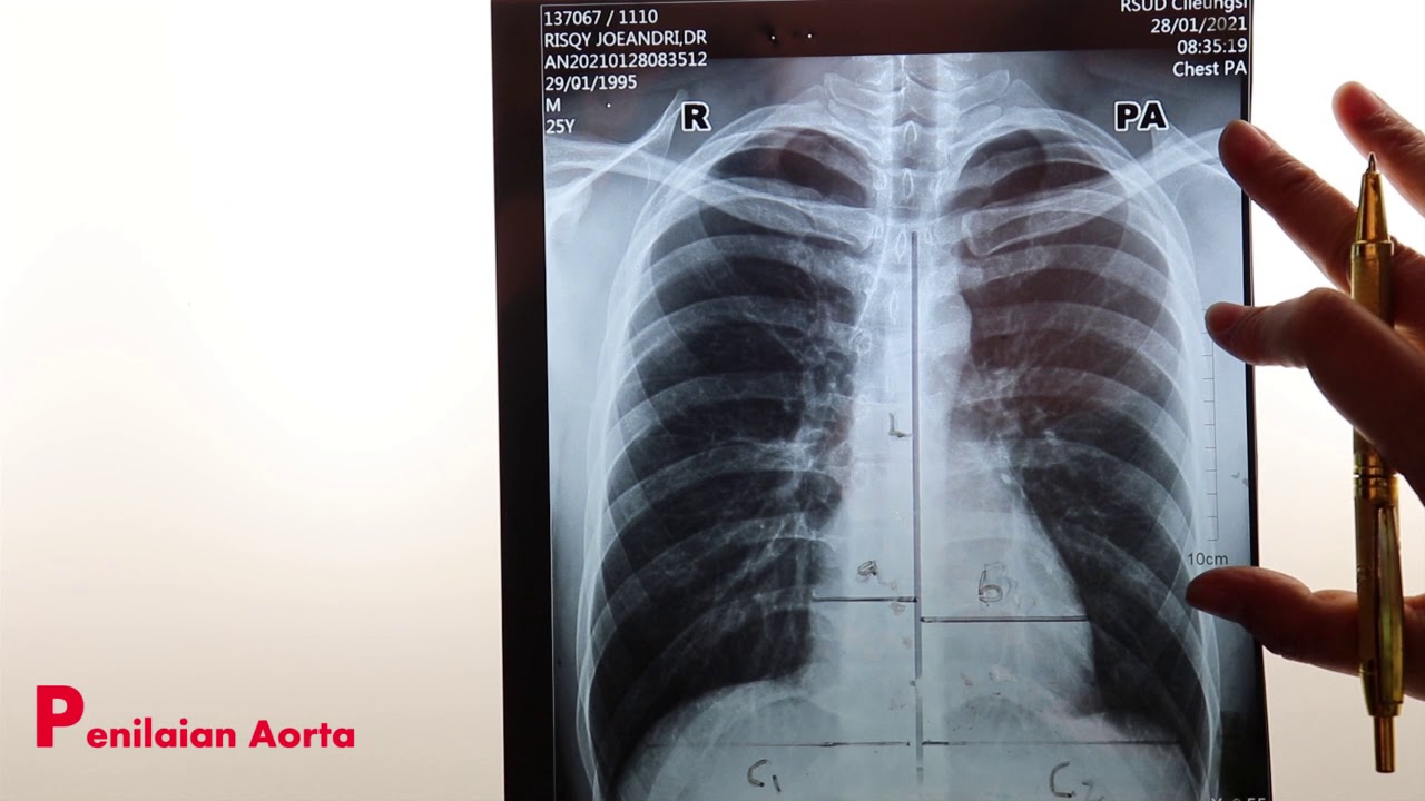 Pembacaan x ray dada (thorax). Skill penting untuk dimiliki. #salambelanegara