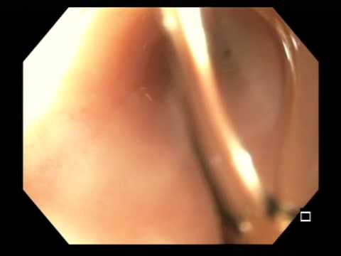 Przewód moczowo-jelitowy i zespolenie jelita krętego i moczowodu