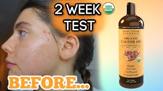 I TESTED PURE CASTOR OIL ON MY FACE FOR MY ACNE SCARS FOR 2 WEEKS || My review and thoughts!